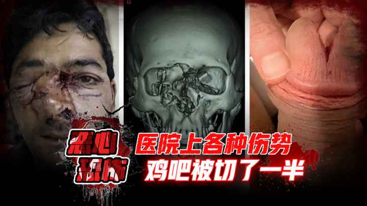 【恶心恐怖】医院上各种伤势，鸡吧被切了一半，看着都疼 的封面